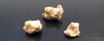 Νεφρολιθίαση: Πέτρες κυστίνης