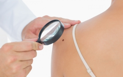 Καρκίνος του δέρματος: Τα σημάδια που προειδοποιούν