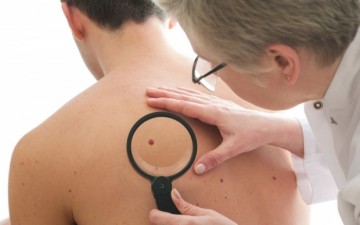 Καρκίνος του δέρματος: Πώς να καταλάβετε ότι μια ελιά είναι επικίνδυνη