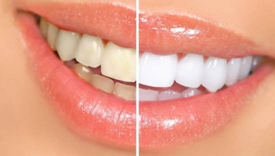 Λεύκανση δοντιών:Πώς θα γίνουν τα δόντια σας εκτυφλωτικά;
