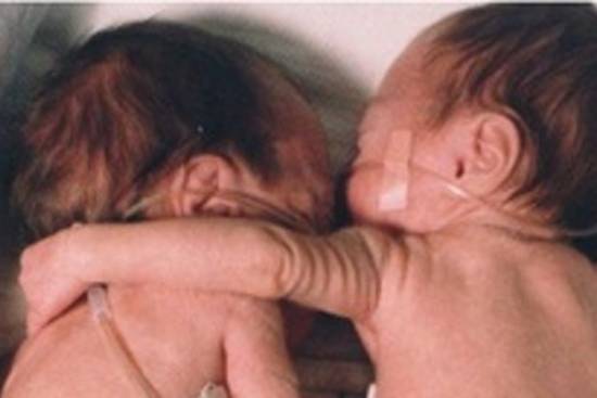 Νεογέννητα αγκαλιάζονται για να επιβιώσουν
