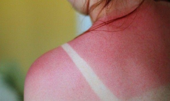 Οδηγός για τα ηλιακά εγκαύματα