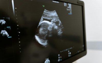Η πρώτη εγκυμοσύνη με εξωσωματική γονιμοποίηση μετά από καρκίνο του ενδομητρίου στην Ελλάδα