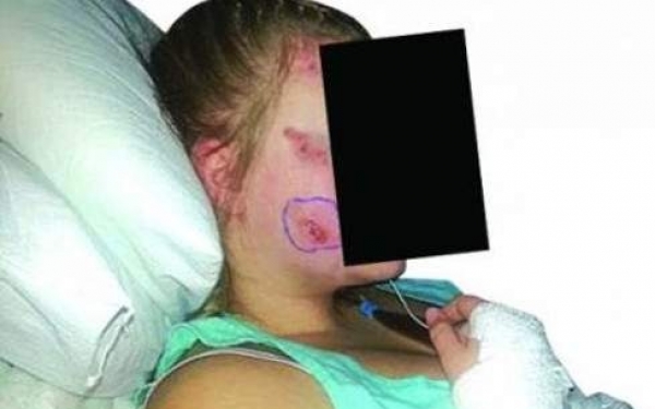 Εικόνα-σοκ της γυναίκας από την Πάτρα που τσίμπησαν οι τσούχτρες -Τη σημάδεψαν στο πρόσωπο