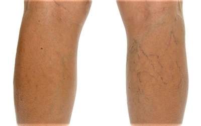 Πώς μπορείτε να θεραπεύσετε τους κιρσούς ανώδυνα