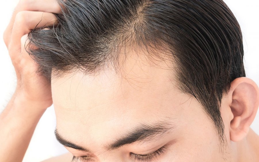 Τριχόπτωση: Η βιταμίνη που δυναμώνει τα μαλλιά – Οι τροφές που την περιέχουν