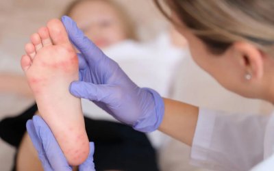Ιός Κοξάκι στα παιδιά: Τι πρέπει να γνωρίζουν οι γονείς – Συμπτώματα και πρόληψη