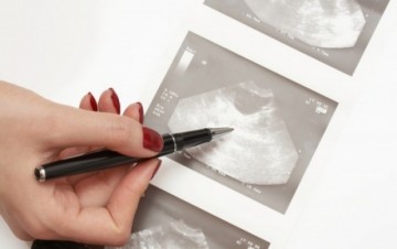 Σύνδρομο Πολυκυστικών Ωοθηκών - Όσα πρέπει να ξέρεις