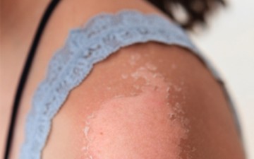 Χρήσιμες συμβουλές για να μην ξεφλουδίσετε