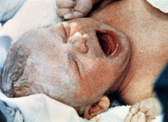 To 1978 γεννήθηκε η Λουίζ Μπράουν, το πρώτο «παιδί του σωλήνα»   (Φωτογραφία:  Associated Press ) 