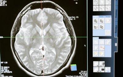 Νέο τεστ αίματος ανιχνεύει το Αλτσχάιμερ χρόνια πριν τα πρώτα συμπτώματα
